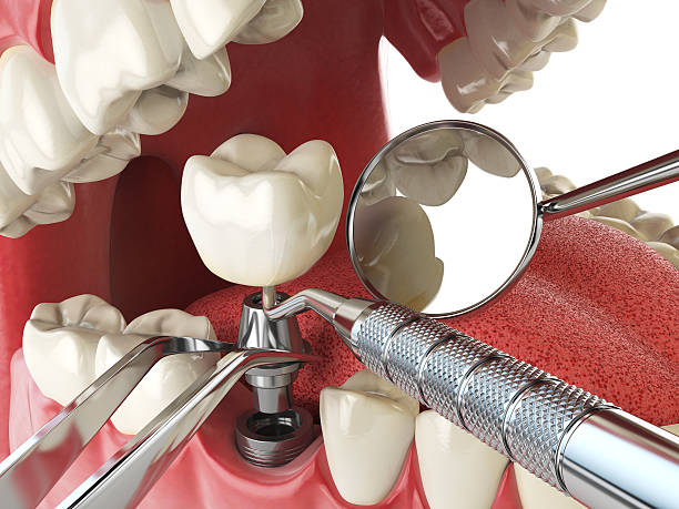 Best Broken Tooth Emergency  in Carroll, IA